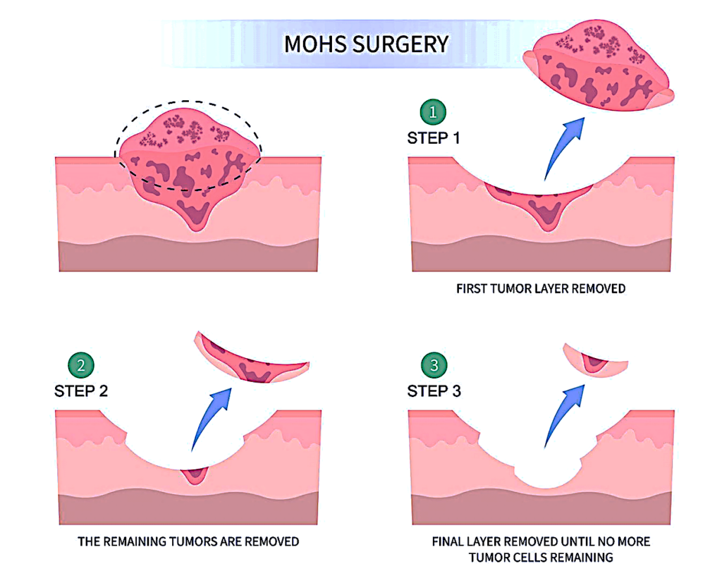 Mohs Surgery